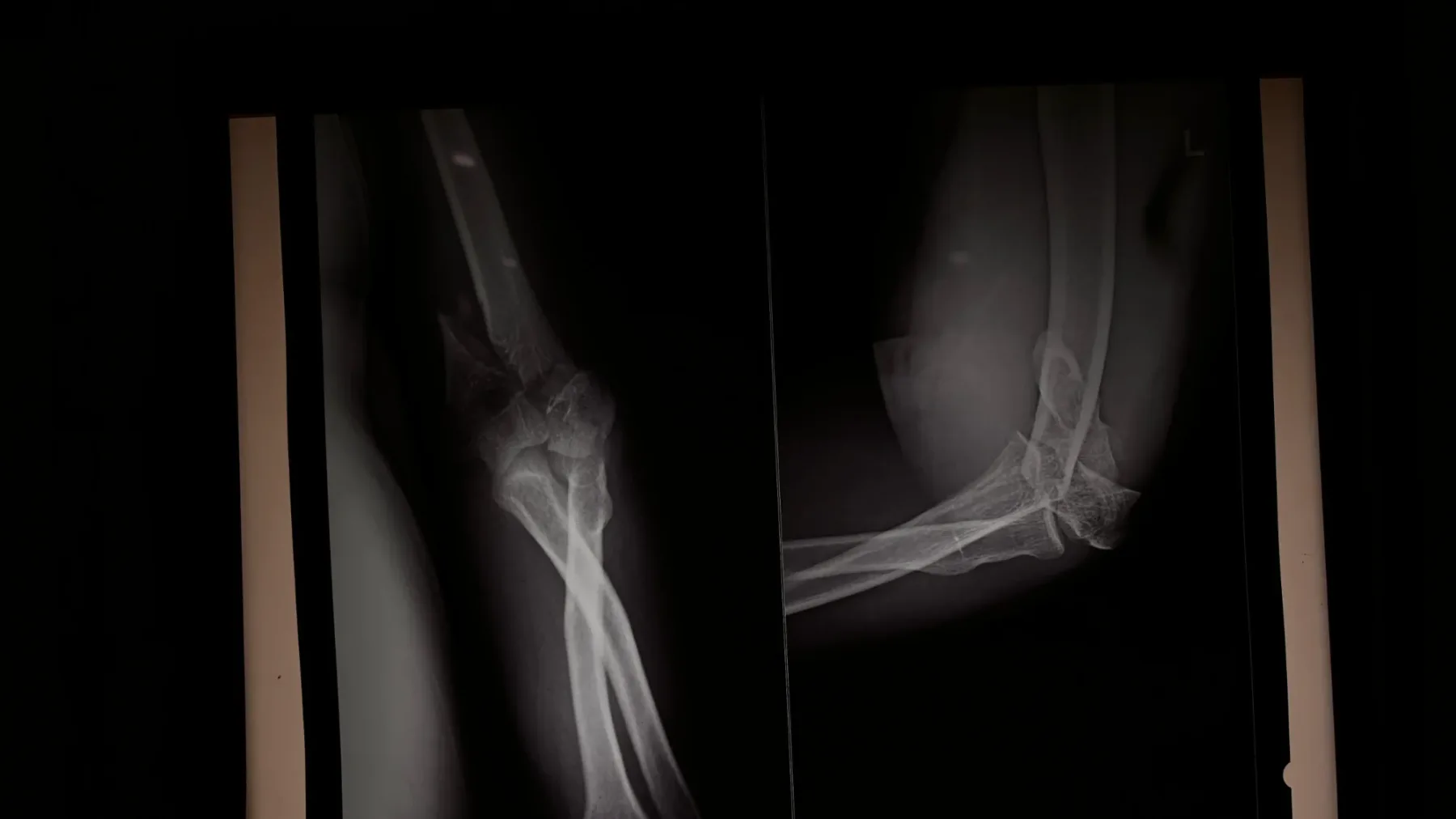 X-ray of an elbow broken into several pieces, the joint surface split apart after a fall.