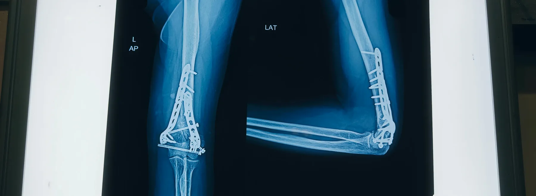 X-ray of a healed elbow with the joint rebuilt and plates holding the bone, the arm restored to a near-full range of movement.