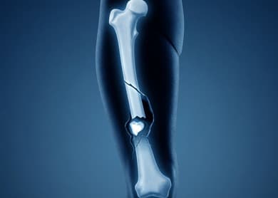 An X-ray of a human hand and wrist displayed on a viewing screen.